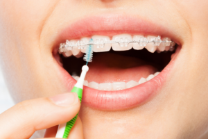 Cleaning ceramic braces with an interdental brush