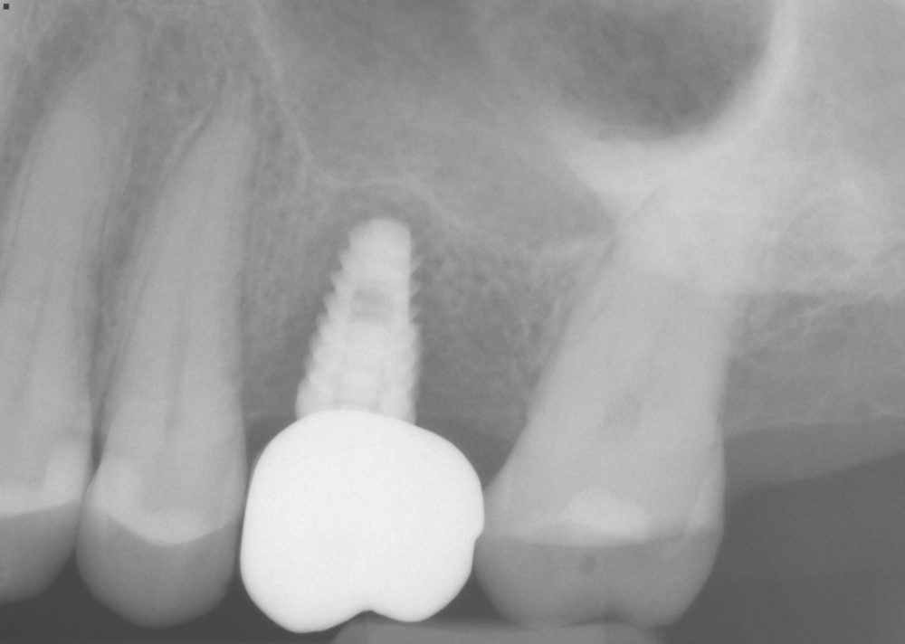 X-ray of a dental implant with crown