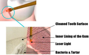 Laser gum treatment diagram