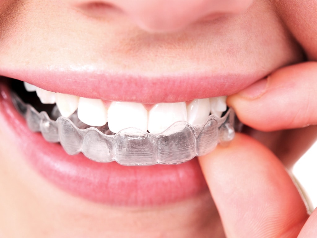 Clear Invisalign aligner being placed on teeth