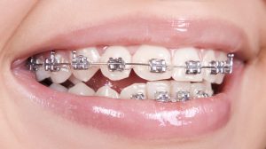 Braces and orthodontics