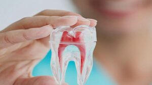 Root canal treatment