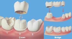 Crowns and bridges