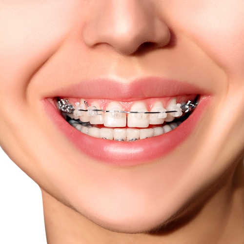 Smile with dental braces
