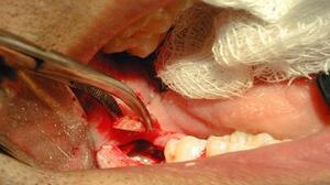 Wisdom tooth removal procedure