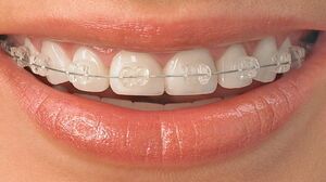 Invisalign-ceramic-braces-0