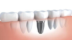 dental-Implants-img